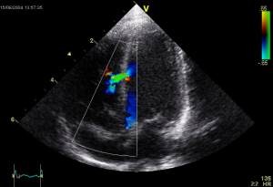 Imagen de una ecocardiografía