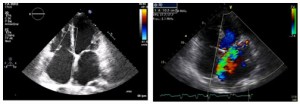 Imagen de un ecocardiograma realizado mediante ultrasonidos