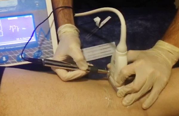Neuromodulación en el nervio peroneo común. ¿Quiéres ver aplicar esta técnica de NMP? Pues mira el vídeo que le hicimos al fisioterapeuta en nuestra clínica.... Fotografía de manos trabajando sobre una pierna con ecógrafo y neuroestimulador